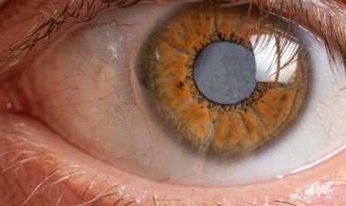 Glaucoma atinge 2,5 milhões de pessoas no país e pode causar a perda de visão irreversível