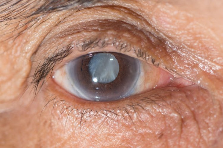 Dia Nacional de Combate ao Glaucoma: Dr. Marcelo Taveira alerta para a importância do diagnóstico precoce