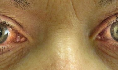 Dia Nacional de Combate ao Glaucoma: Dr. Marcelo Taveira alerta para a importância do diagnóstico precoce