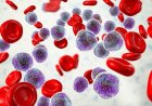 Quando o câncer do sangue não dá sinais: o desafio das leucemias crônicas