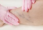 Agosto Azul Vermelho reforça prevenção das doenças vasculares no RN e confirma realização do Check-up Vascular gratuito