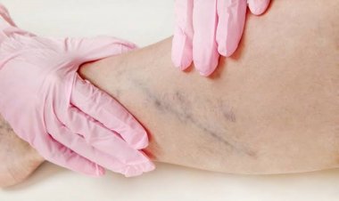 Agosto Azul Vermelho reforça prevenção das doenças vasculares no RN e confirma realização do Check-up Vascular gratuito