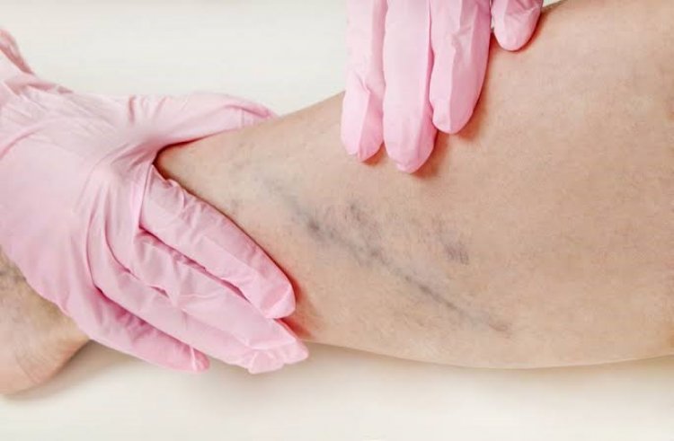 Agosto Azul Vermelho reforça prevenção das doenças vasculares no RN e confirma realização do Check-up Vascular gratuito