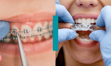 Como funciona um tratamento dentário com alinhadores invisíveis?
